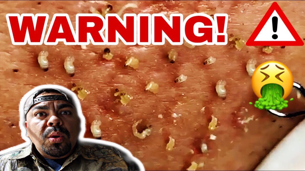 Infested Blackhead Pimple Popping Extraction Video REACTION!