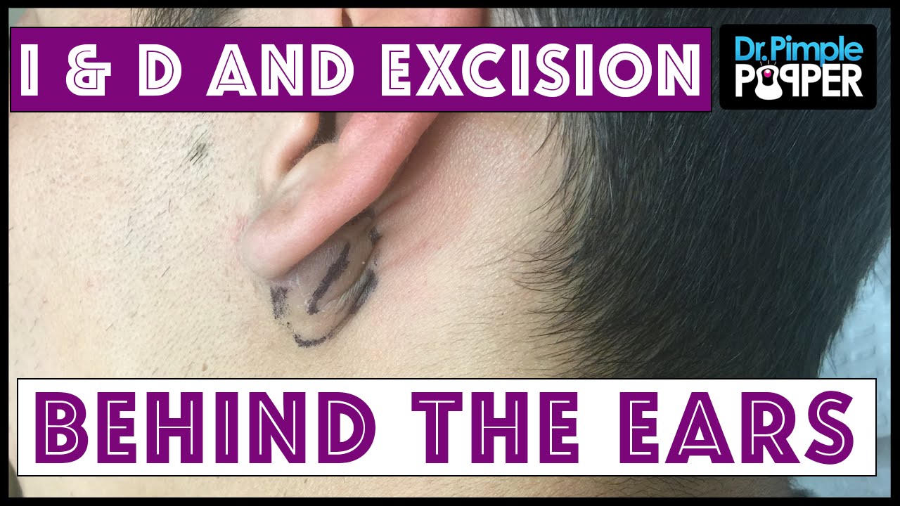 Inflamed and Non-Inflamed Cyst Removals, Behind Ears