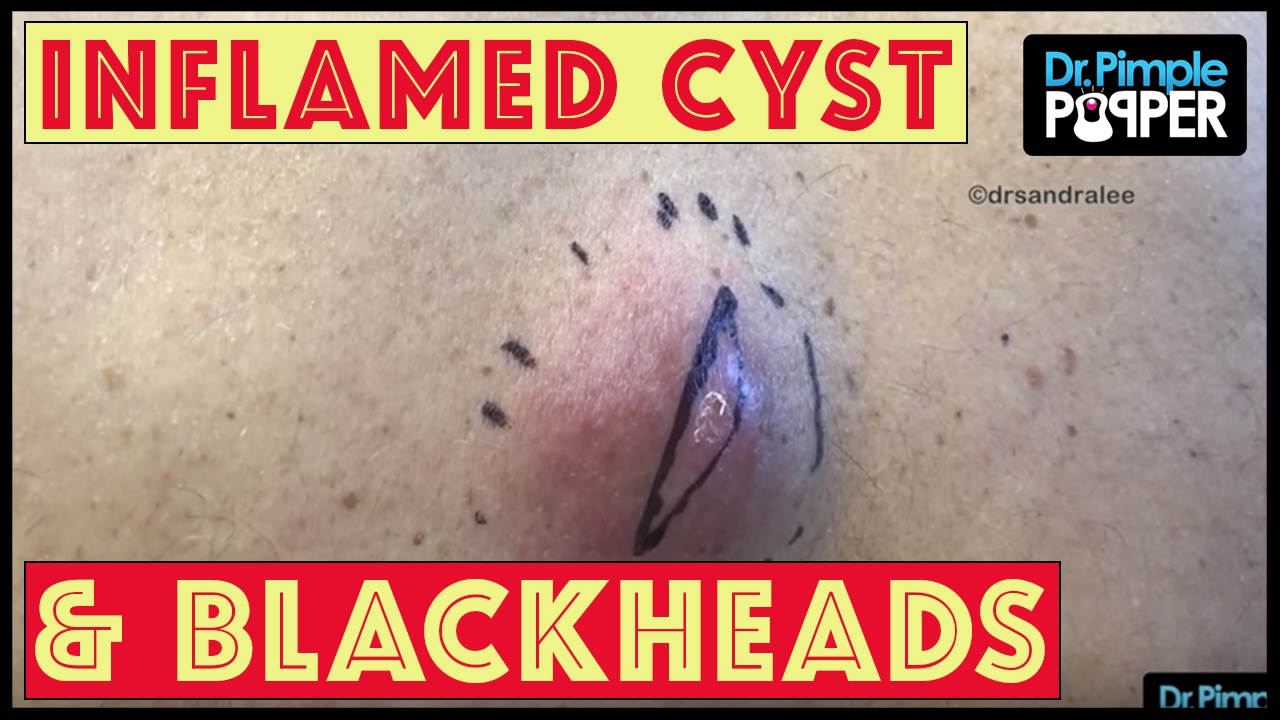 Inflamed cyst AND back blackheads aka Favre racouchot