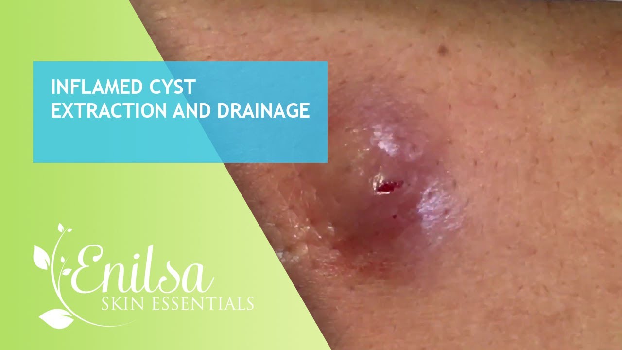 Inflamed Cyst Extraction and Drainage