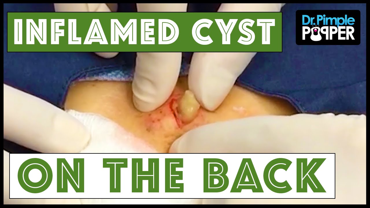 Inflamed Cyst on the Back of a Popaholic’s Sweet Mom!