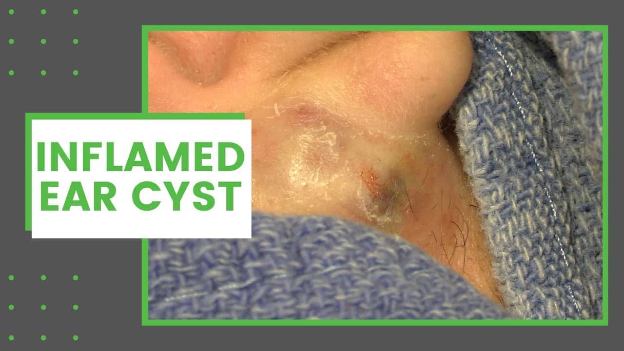 Inflamed Ear Cyst | Dr. Derm