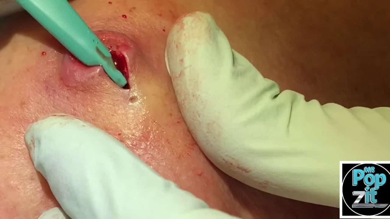 Inflamed Half cyst/ half abscess. Drainage, pop, and closure. Scrape out all contents and close.