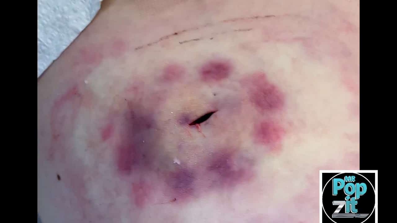 Inflamed thigh abscess under pressure. I+D of inflamed cyst. Juicy pop. Pressure release. MrPopZit.