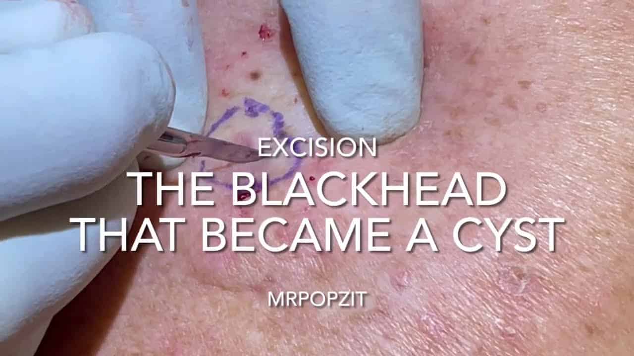 Ingrown hair cyst. The blackhead that grew up to become a cyst. Cool ingrown hair in the middle.