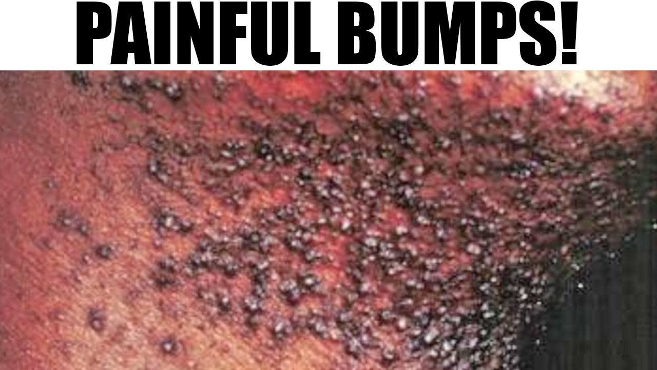 Ingrown Hair, Razor Bumps or Pimples?
