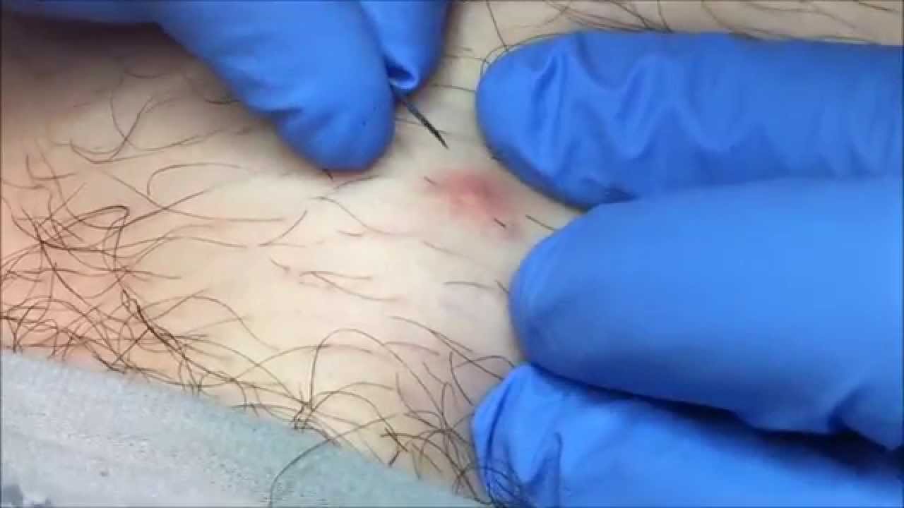 Ingrown Hair Removal on Man’s Leg