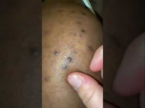 Ingrown hair removal, pimple-popping, and acne