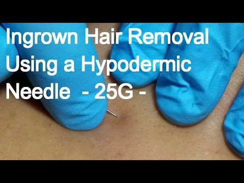 Ingrown Hair Removal Using a Hypodermic Needle  – 25G –