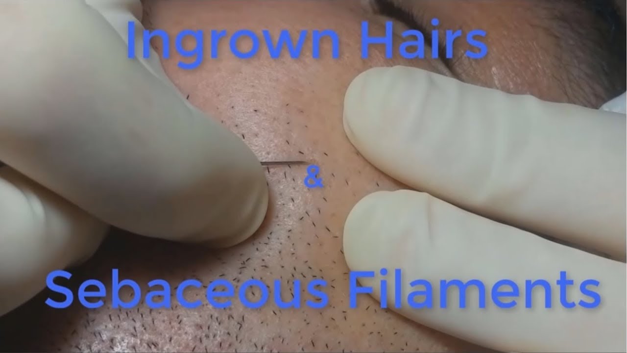Ingrown Hairs and Sebaceous Filaments