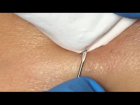 Ingrown Hairs Extraction – 16 minutes-