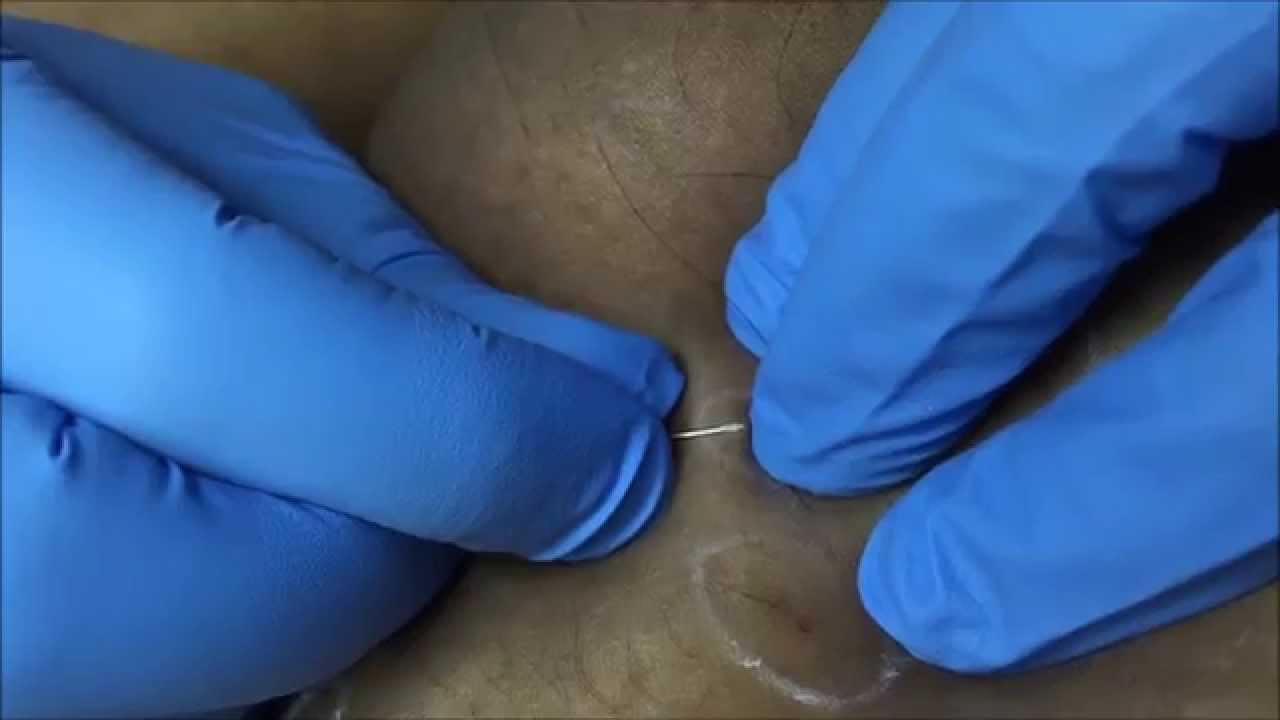 Ingrown Hairs Treatment. Professional Extraction