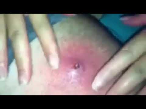 Ingrown, #ingriwn hair, #pimplepopping  Acne, Black head extractions, whiteheads, Cyst #1