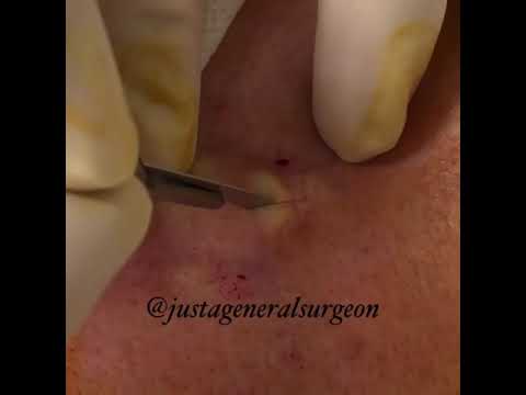 Inside the OR with @justageneralsurgeon – removal of an Epidermoid cyst on the back