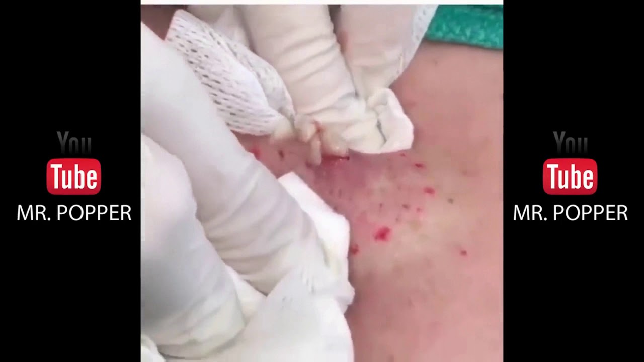 Intense Pimple Popping