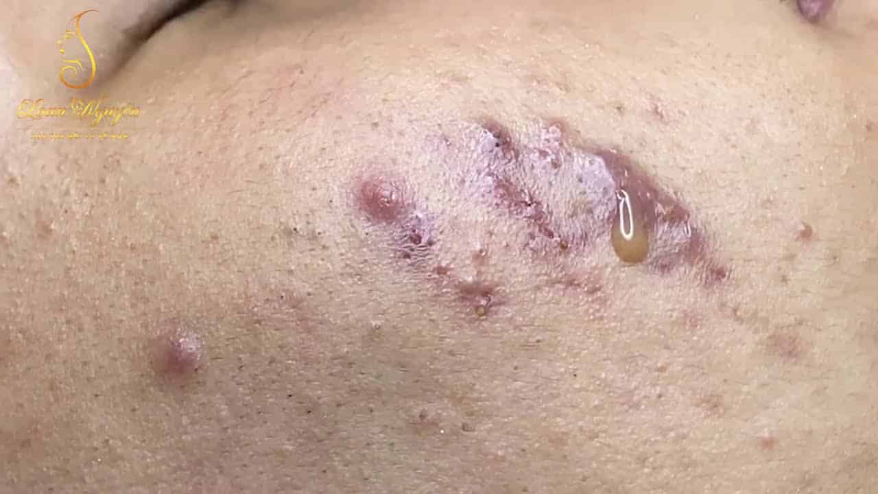interesting with blackheads and whiteheads (274_ep1)