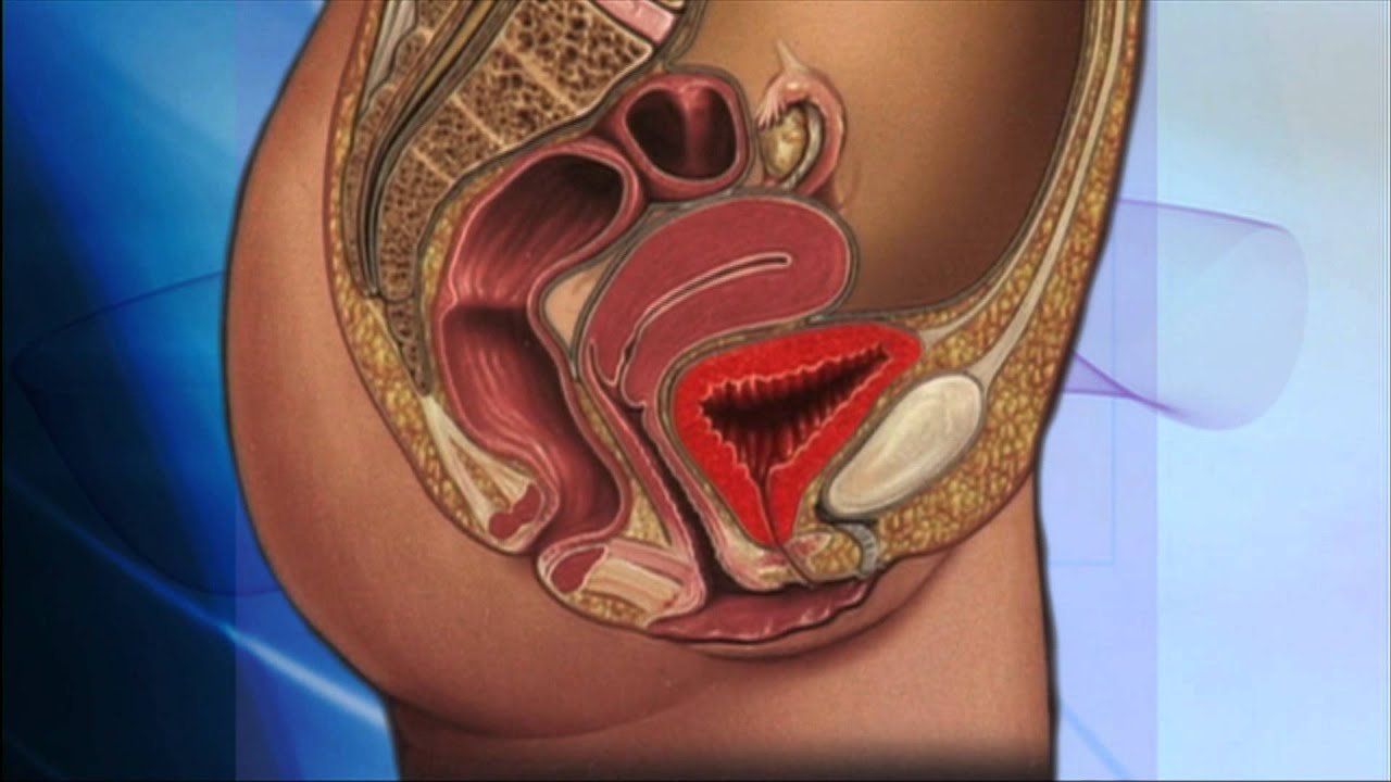 Interstitial Cystitis: Is it Just Another Infection?