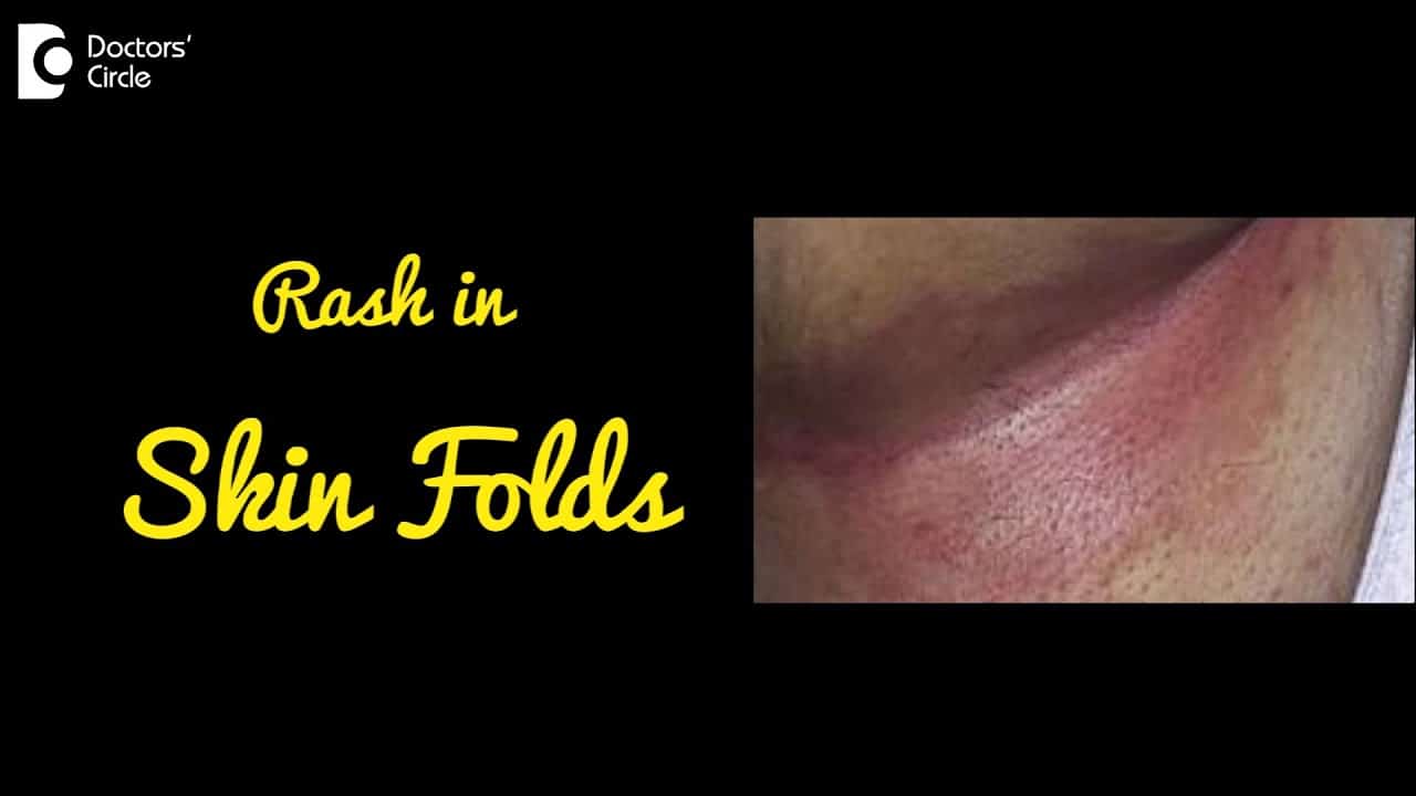 INTERTRIGO | Rash in Skin Folds | Causes, Symptoms, and Treatment – Dr.Nischal K C | Doctors' Circle