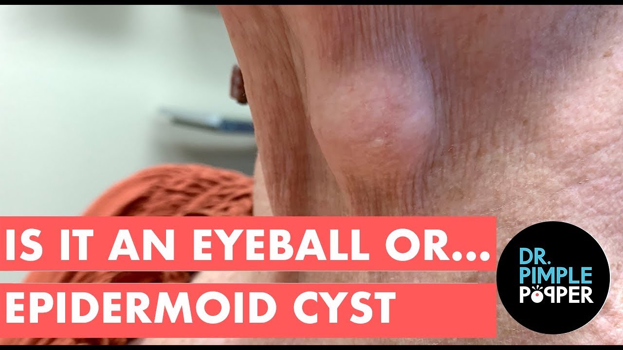 Is It an Eyeball…or Epidermoid Cyst?