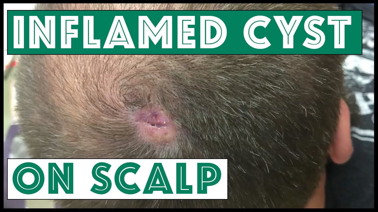 Is this a cyst on the scalp?  To be continued…