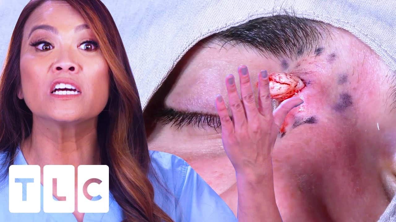 "It Could Push My Eye Out Of The Socket": A Dangerous Eye Cyst | Dr. Pimple Popper