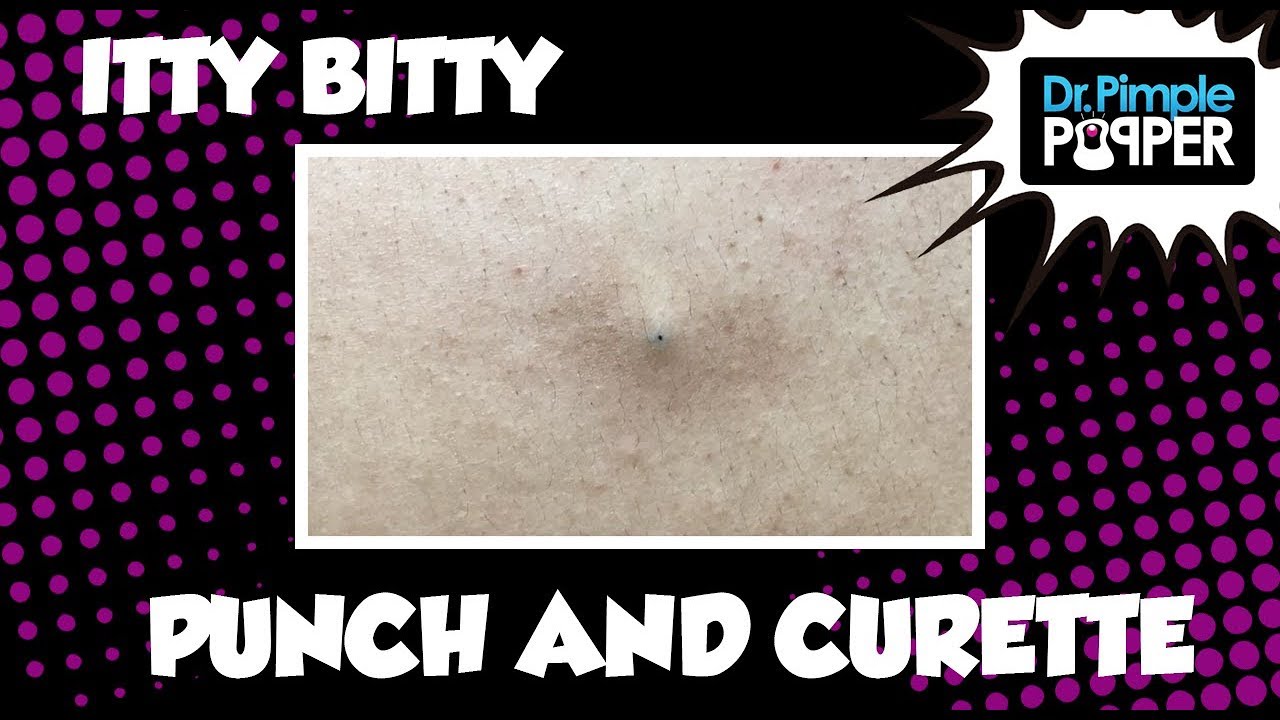 itty bitty punch and curette