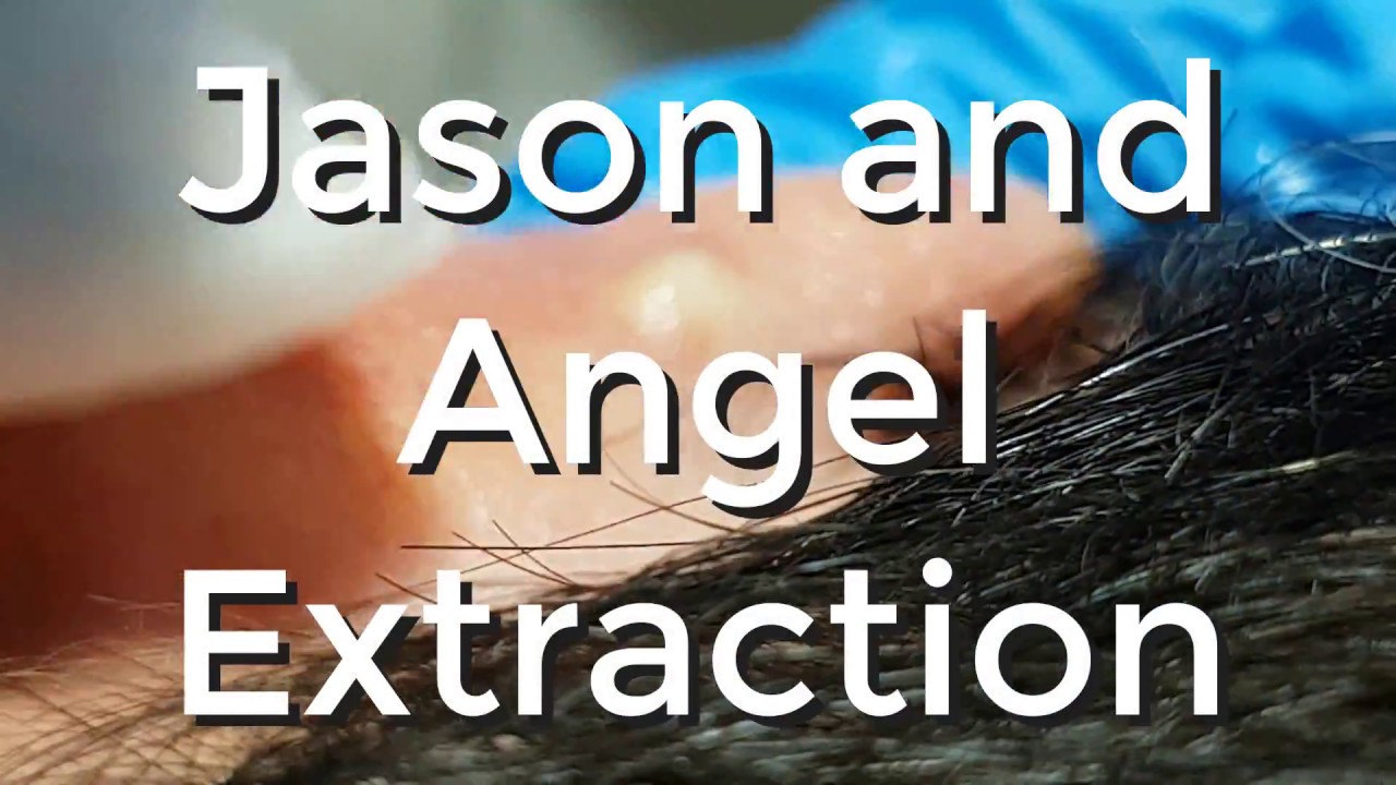 Jason and Angel Extraction