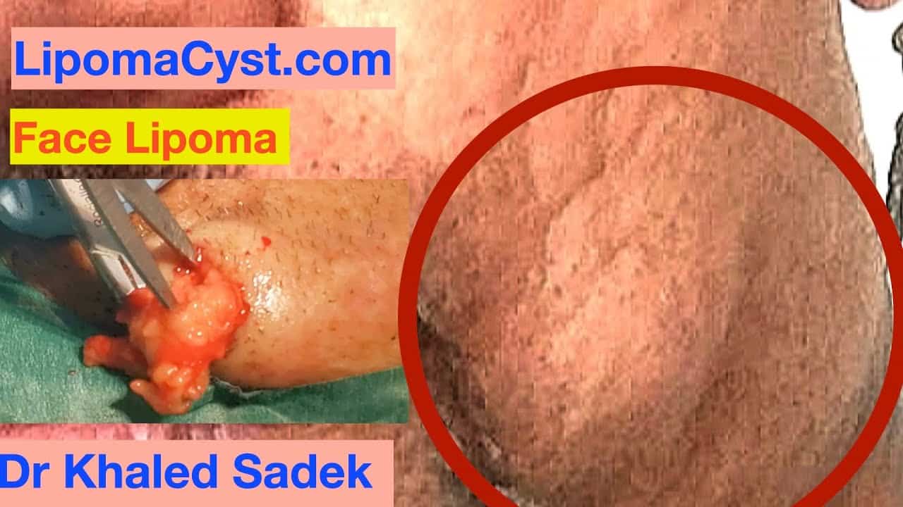 Jaw Dropping Lipoma. Dr Khaled Sadek LipomaCyst.com