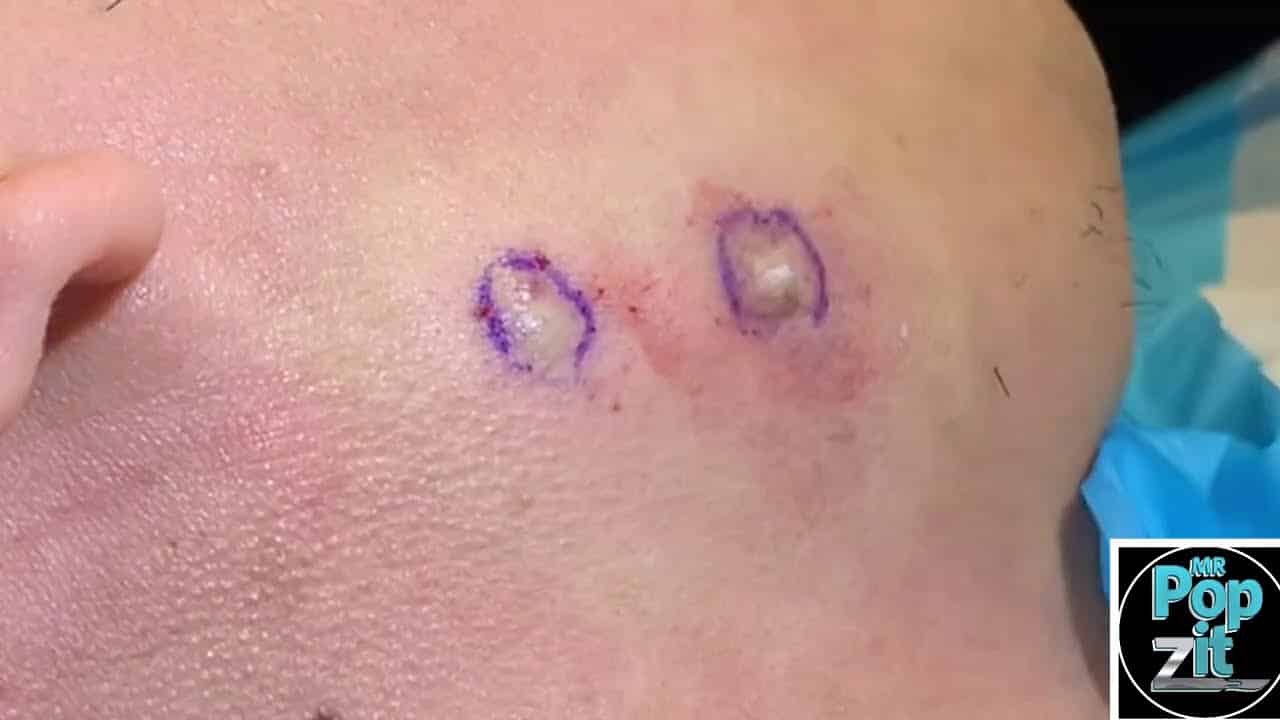 Jawline twinsie cysts. Excision and removal with cyst pop. Cysts under pressure. MrPopZit