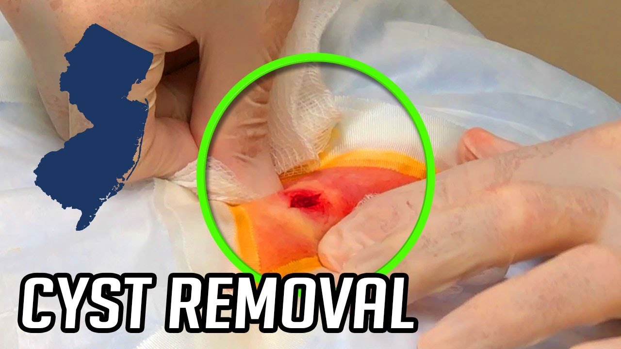 Jersey Guy's Back Cyst Removal – Blackhead Removal Tools