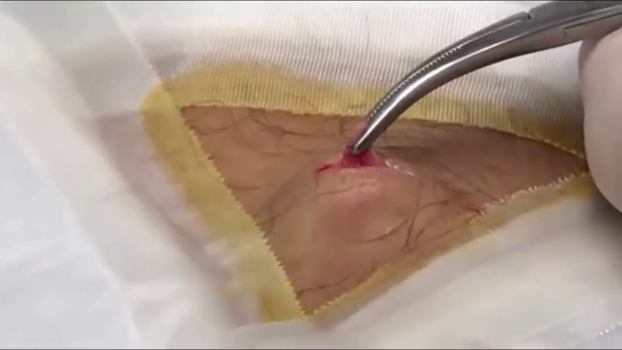 Josie’s Knee Cyst – Part Two (Cyst Popping)