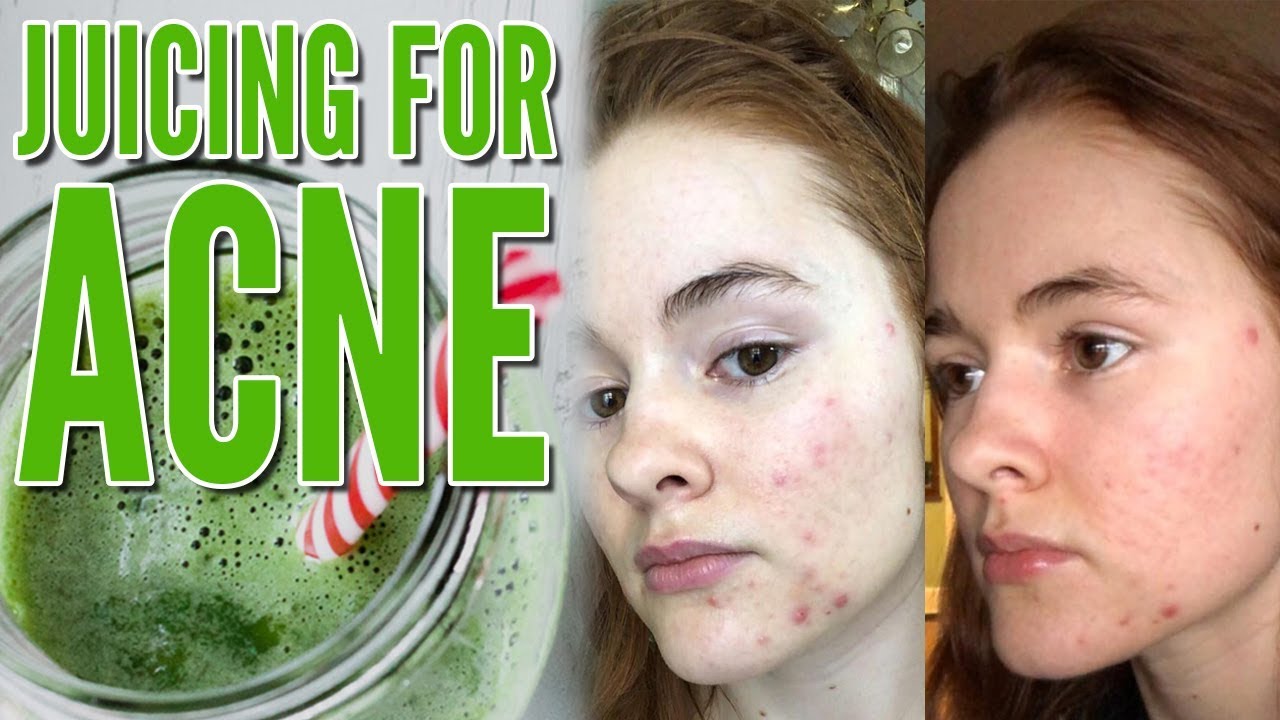 Juicing for Acne (How I Cleared my Acne in FOUR Days!)