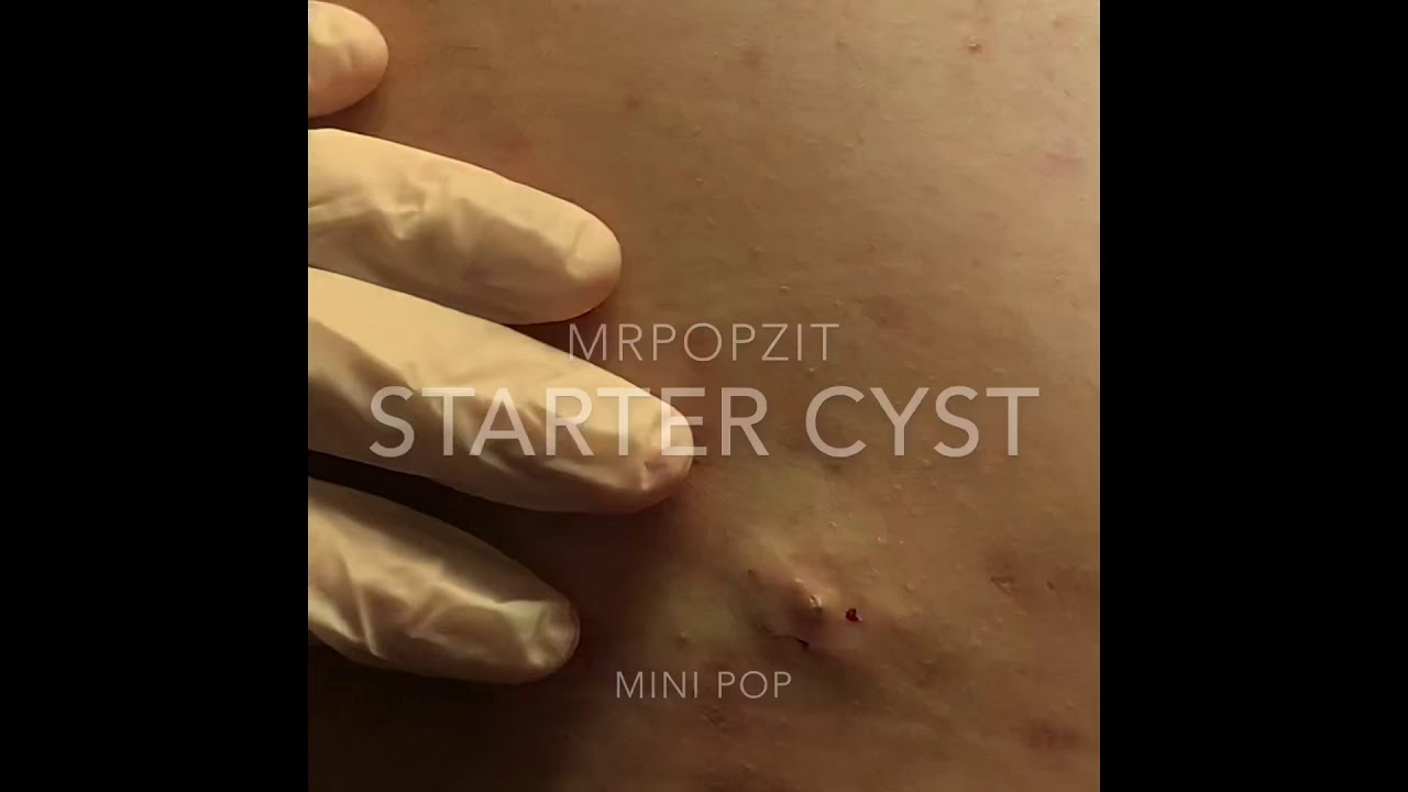 Juicy cyst pop on back! Must see!