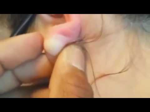 Juicy Pimple Popping Clips