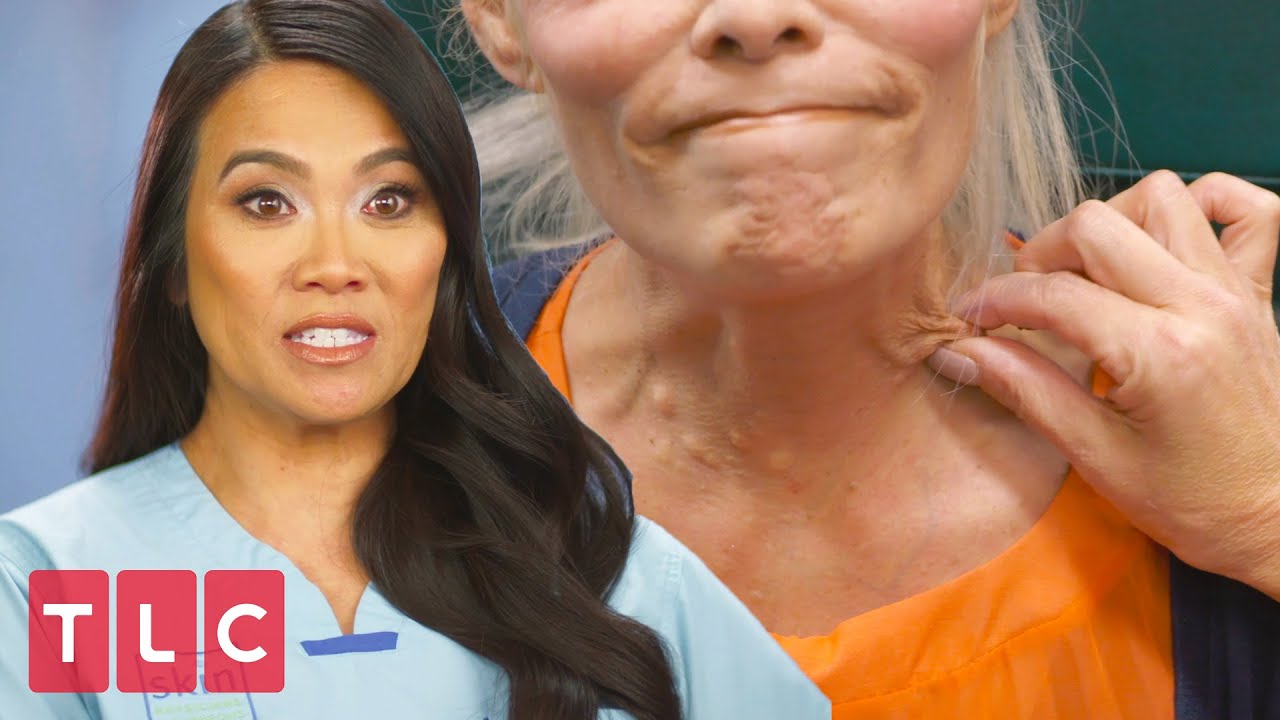 Juliet Has Bumps All Over Her Chest and Neck Area | Dr. Pimple Popper