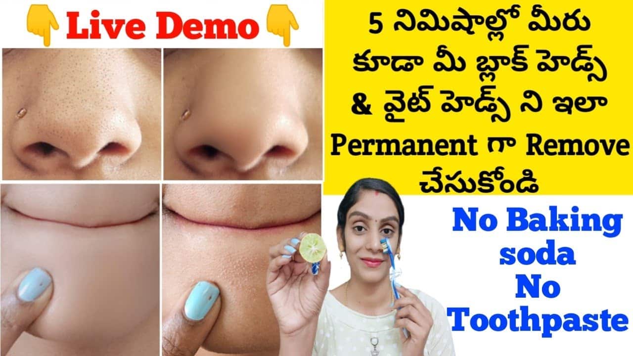 Just 5 Mins Remove Blackheads & Whiteheads At Naturally In తెలుగు || No Baking soda, No Toothpaste