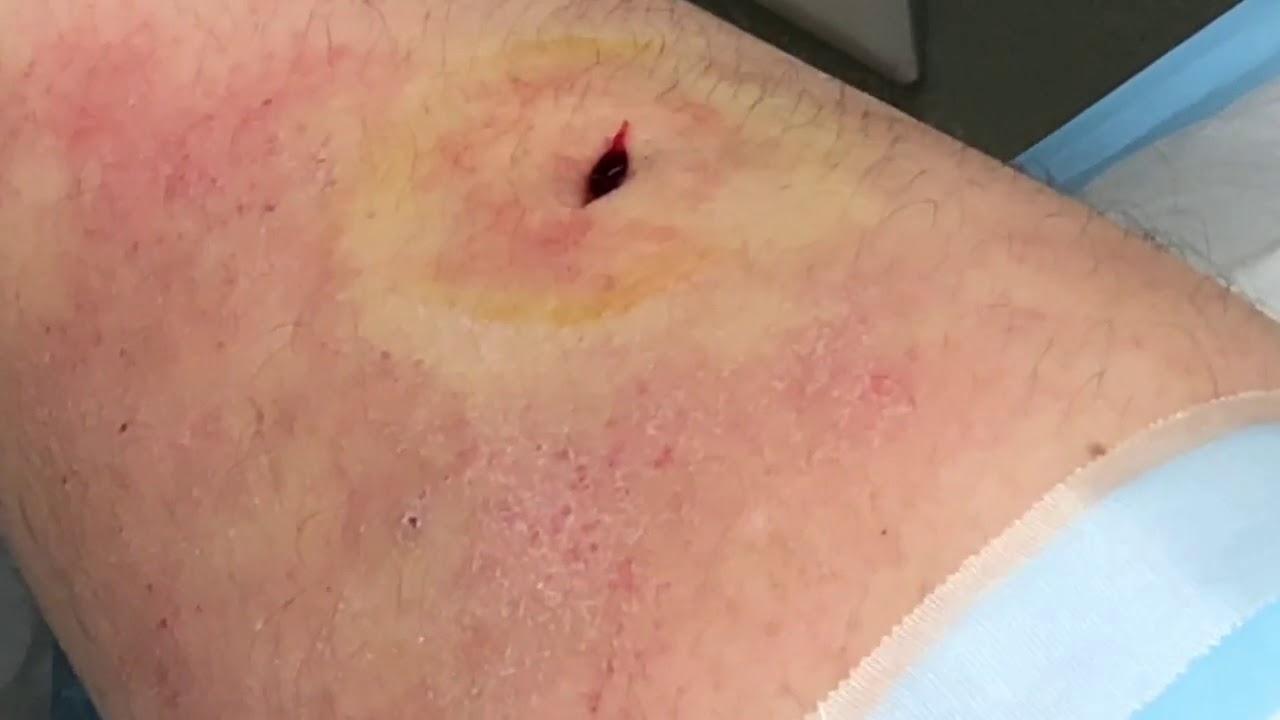 Just the Cyst!  Dr. Gilmore's Cysts, Carbuncles and Blackhead Removal