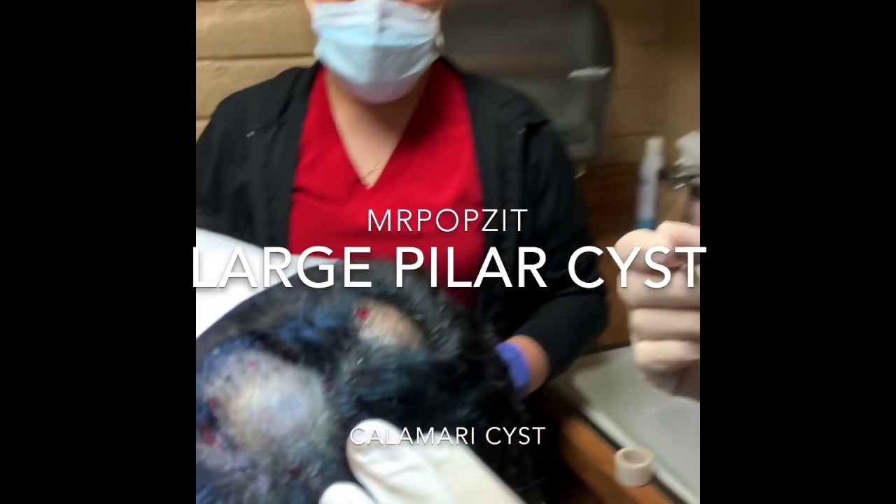 Just the Pop! Large Pilar cyst excision. Cyst pop! Exploding cyst.