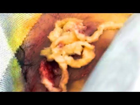 Just the Pop!  Popaholics Rejoice!  (Cyst Removal Demonstration)
