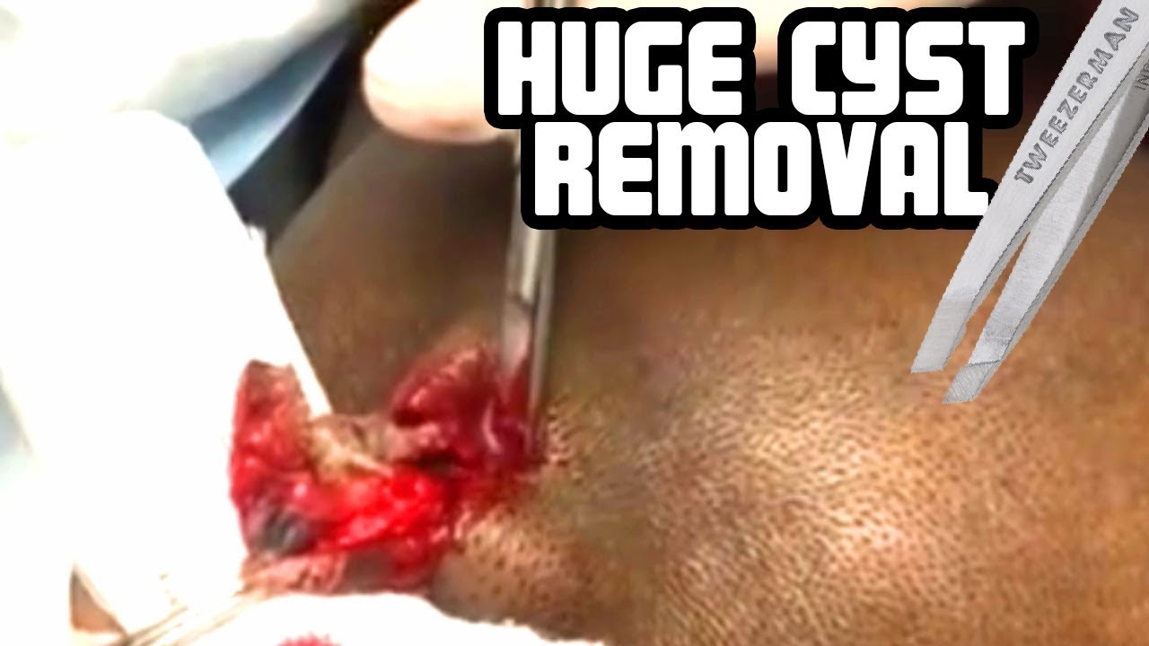 Just the Pop! Scalp Cyst Close Up!  (Trivia Answers at End)