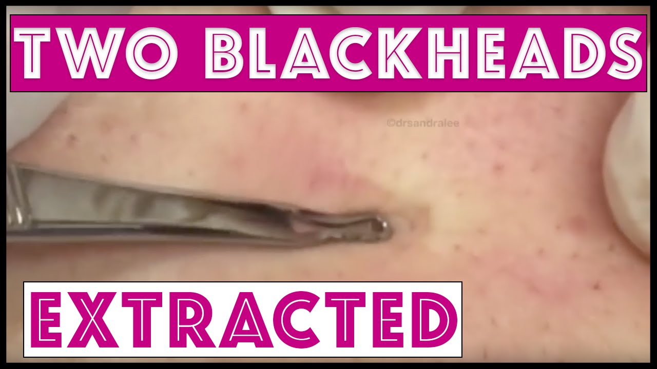 Just two little blackheads on the back…