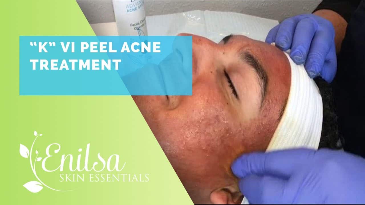 “K” VI Peel Acne Treatment (Full Face View)