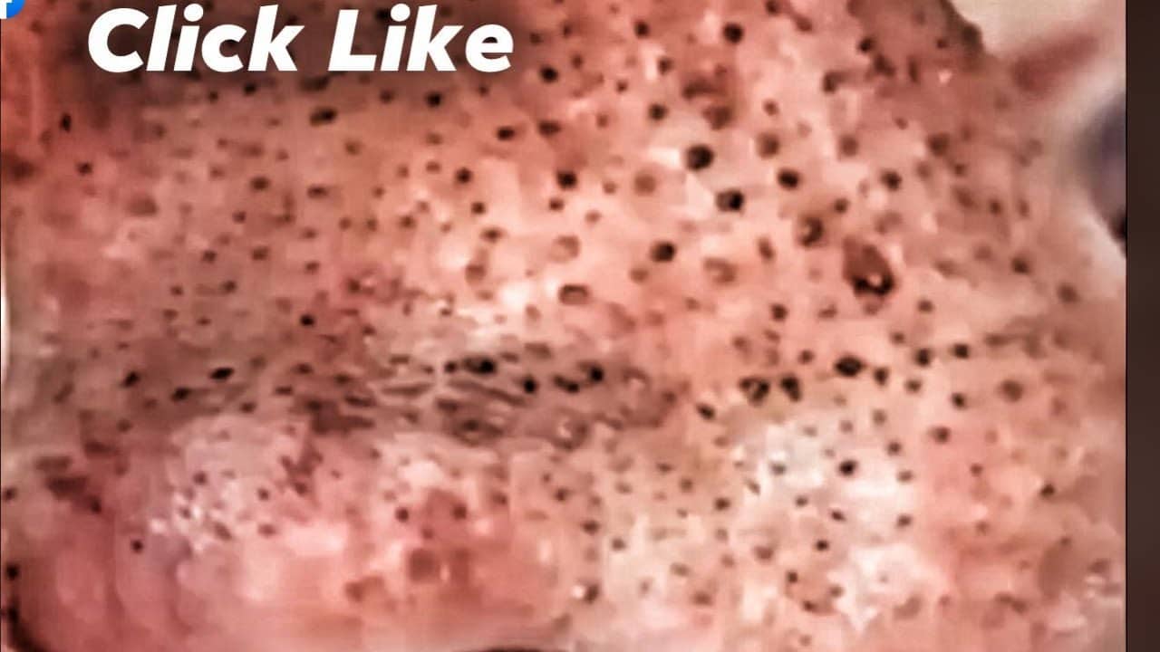 Karen's Extreme Cysts, Clogged Pores and Pimple Pops!  Incredible Acne Compilation