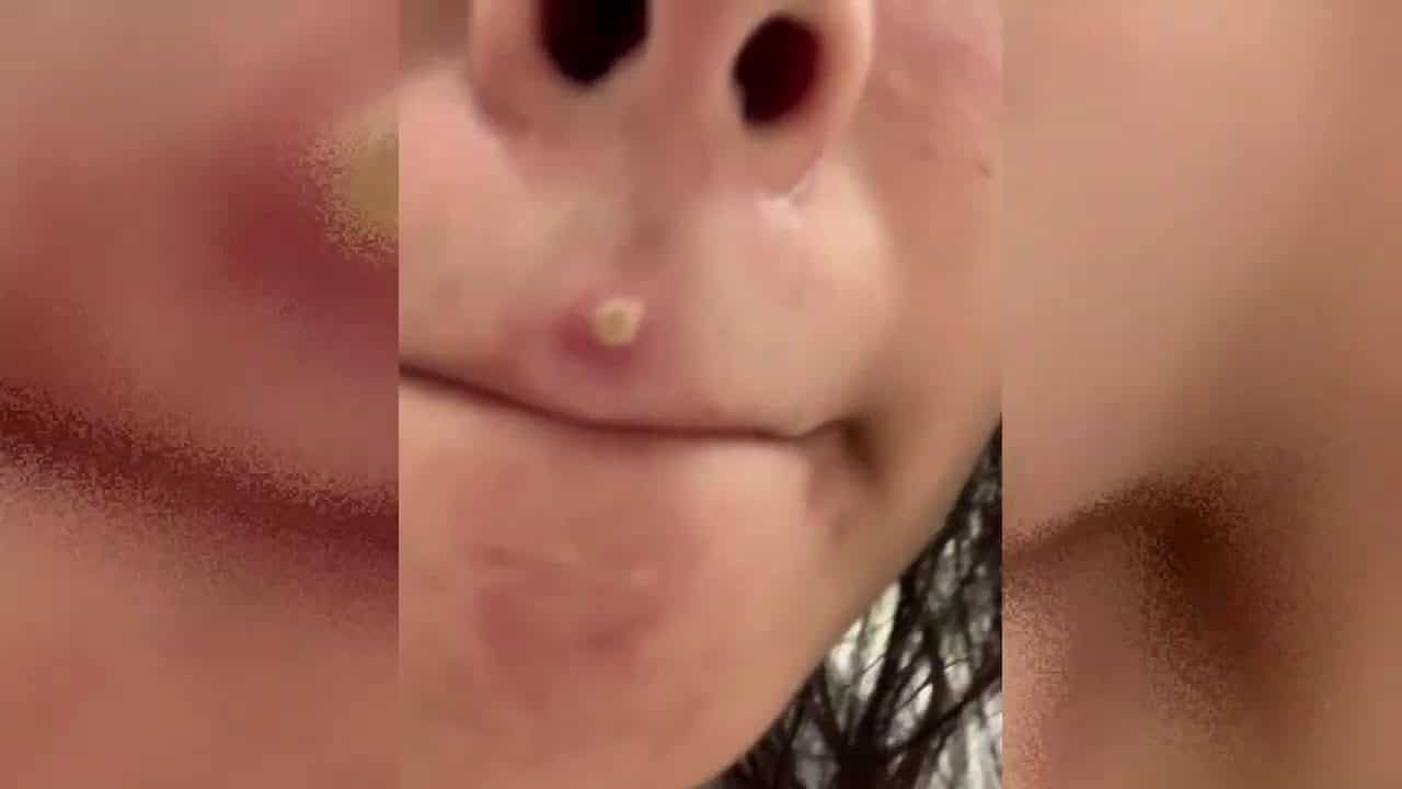 Kaylee's Publix Pimple Pops!  Dermatology, Whiteheads and Zits