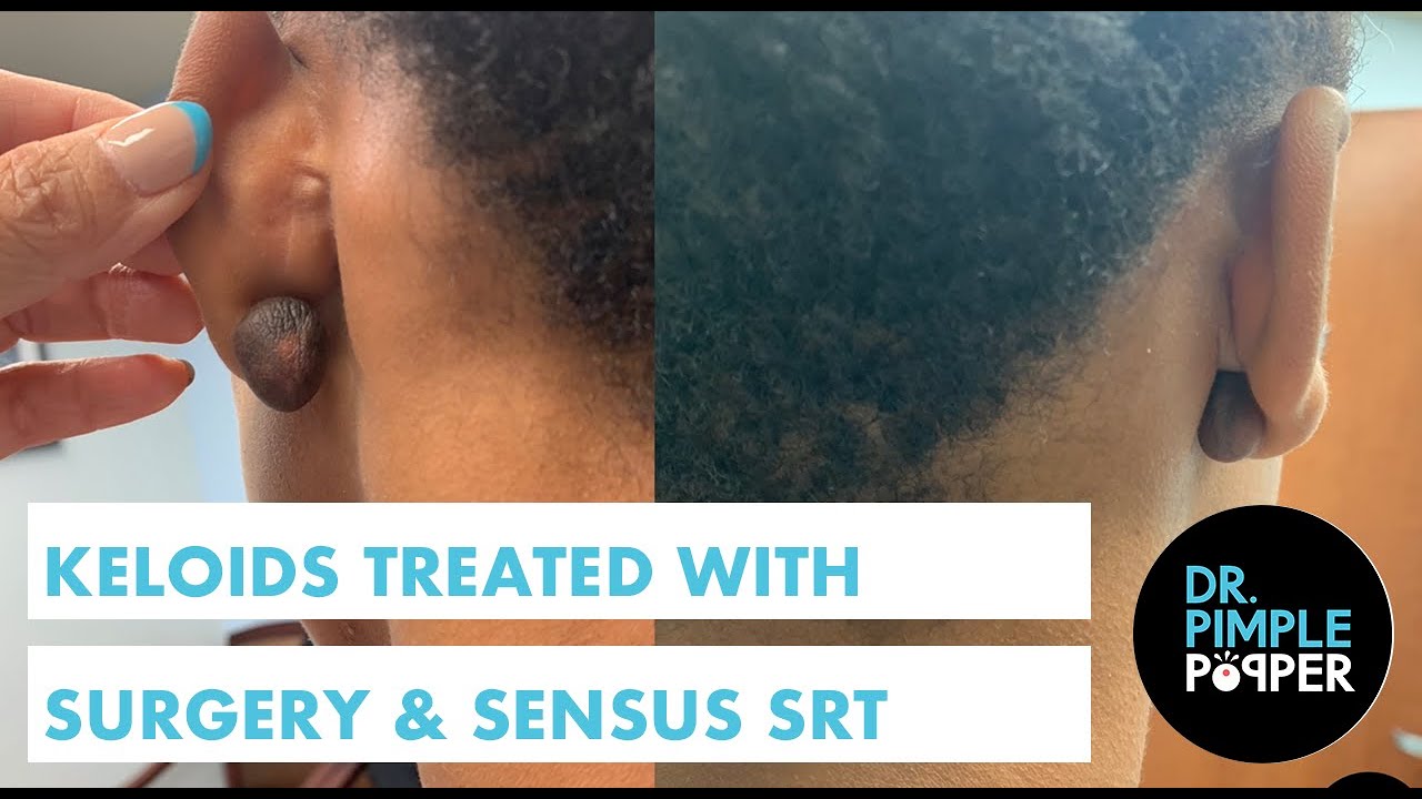 Keloids Treated with Surgery & Sensus SRT