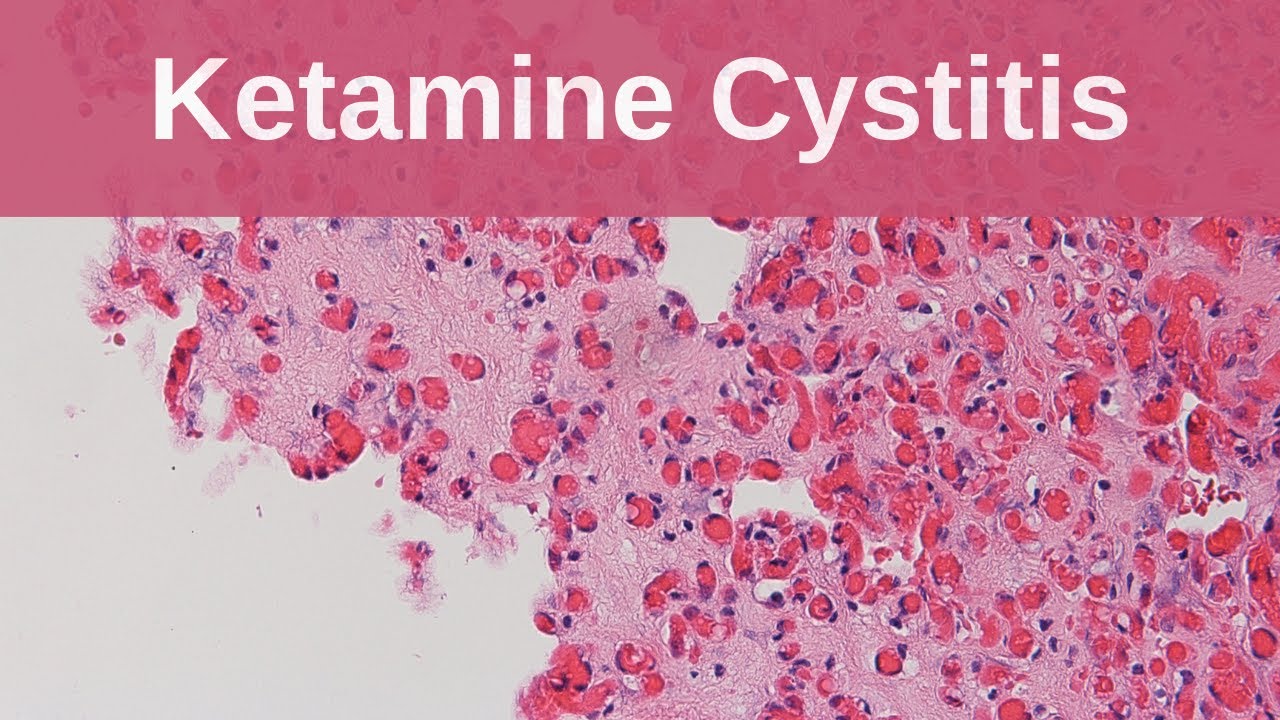 Ketamine Cystitis – Pathology mini tutorial