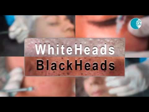 Know All About Whiteheads and Blackheads | Dr Apratim Goel | Cutis Skin Solution