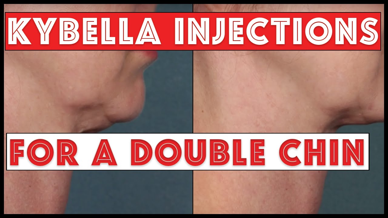Kybella Injections to treat a Double Chin: No Surgery needed