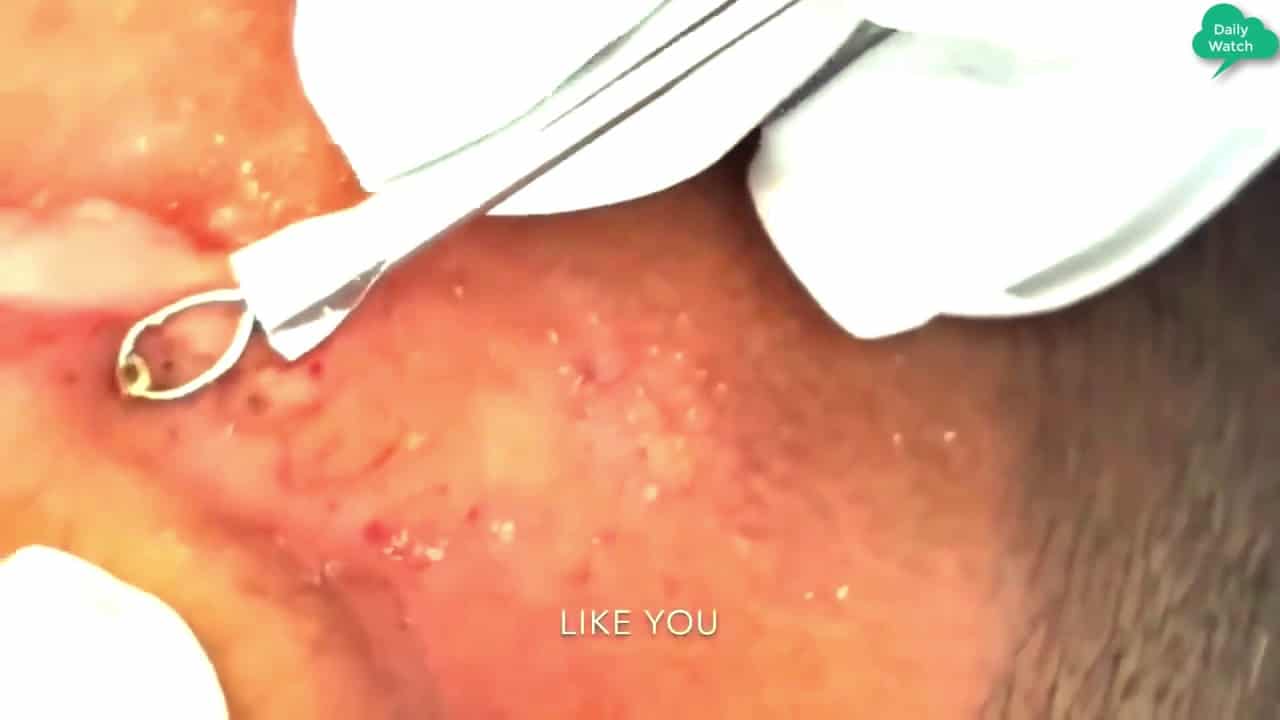 LAGE Blackheads Removal & Pimple Popping Videos 2020