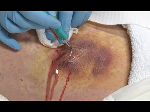 large abscess of the thigh